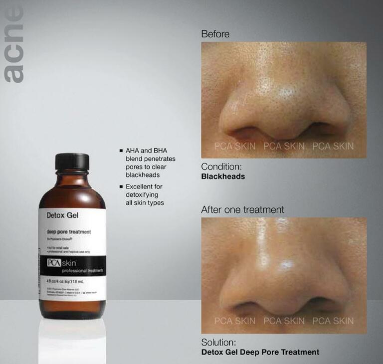 Brand new newest PCA Detoxifying Pore Treatment peel